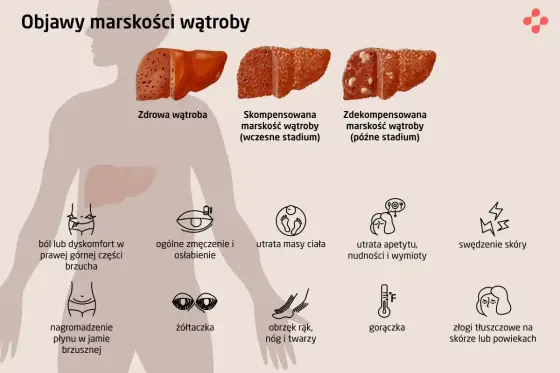 Marskość wątroby - ile się żyje i od czego zależy rokowanie?